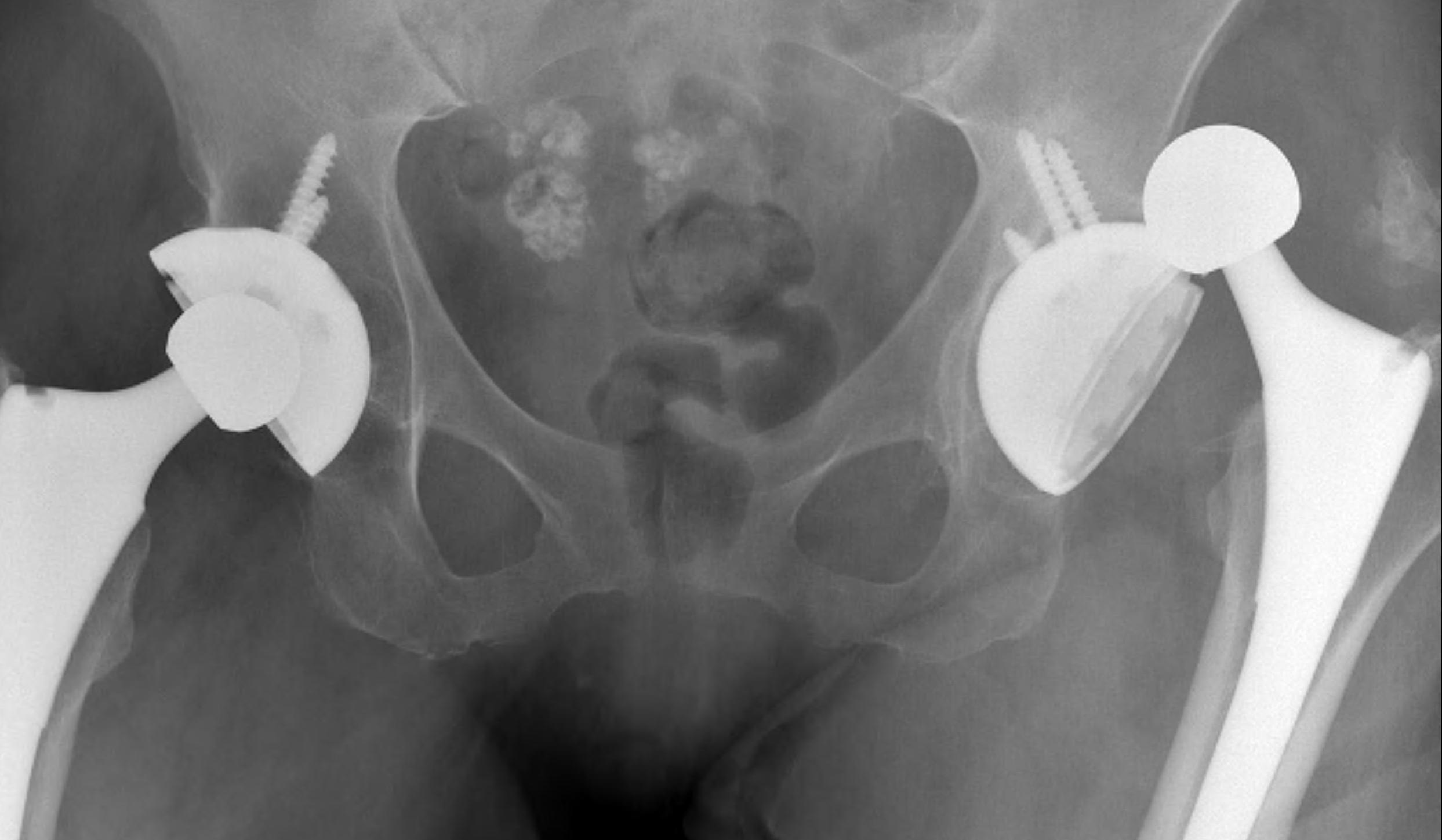 Dislocated THR Open Acetabulum